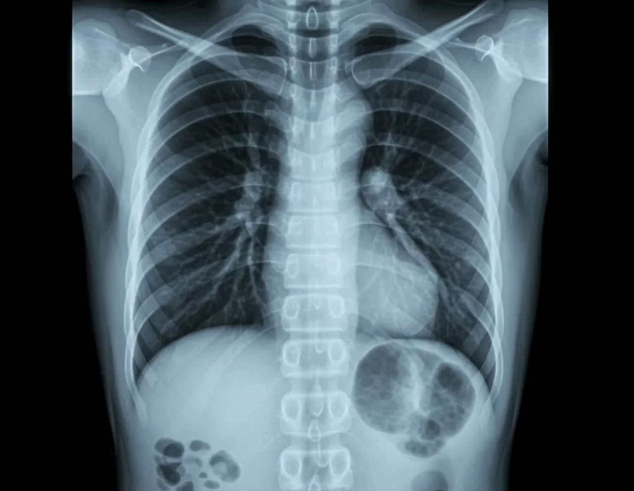 Chest X-Ray