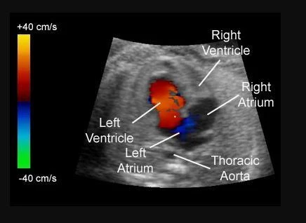 Doppler Ultrasound
